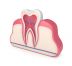 علاج الجذور وعصب الأسنان
